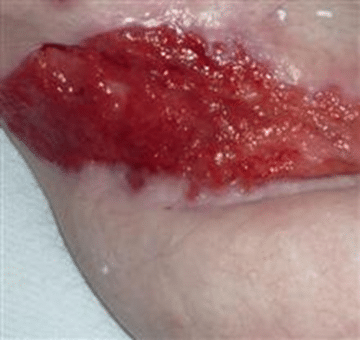 granulation tissue wound