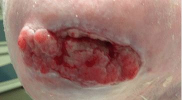 cauterization of granulation tissue