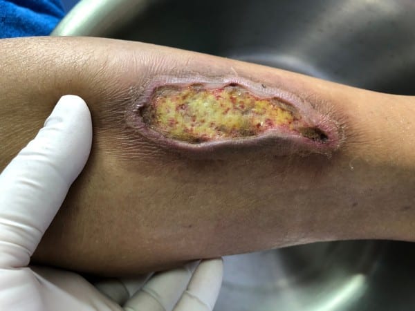 How Can You Tell If a Wound Is Infected? - Sanara MedTech