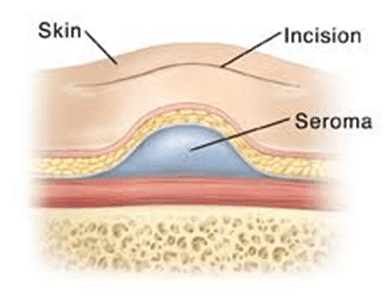 Treating A Post Surgical Seroma Or Hematoma Sanara Medtech