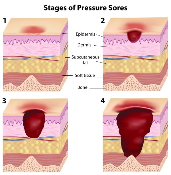 pressure injury stages