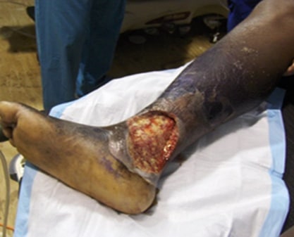 venous leg ulcer
