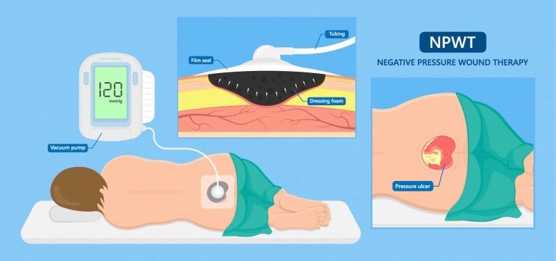 serous drainage