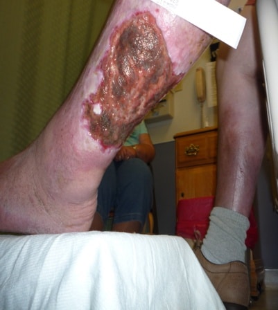 venous leg ulcer