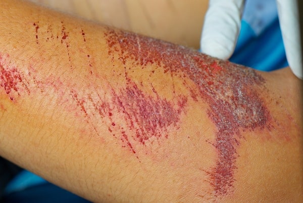 excoriation and abrasion wounds