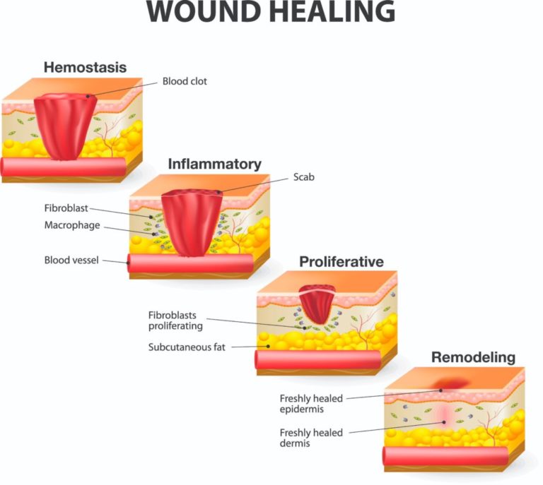 How Do Wounds Heal? A Guide to the Phases of Wound Healing | Sanara Medtech