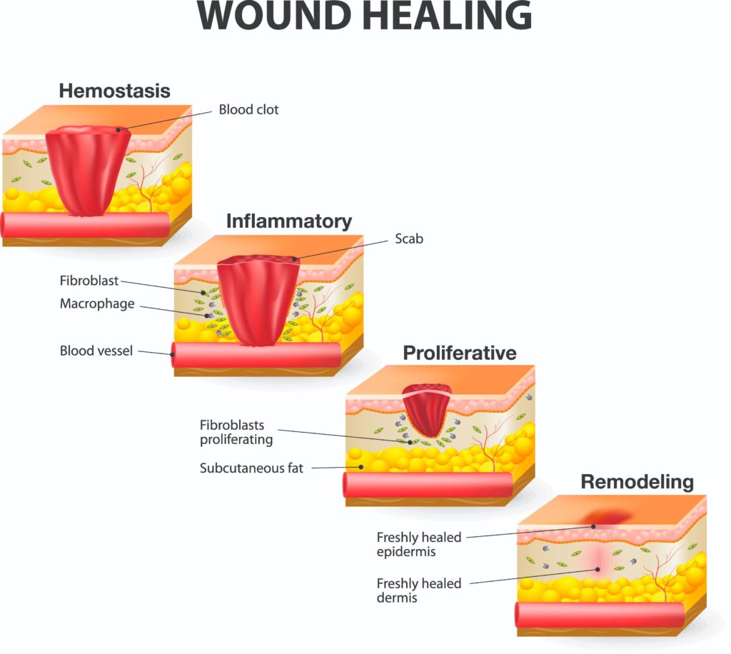 phases of wound healing