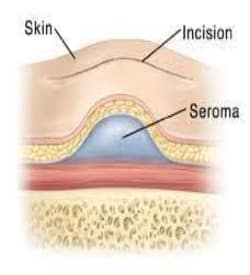 serous drainage color