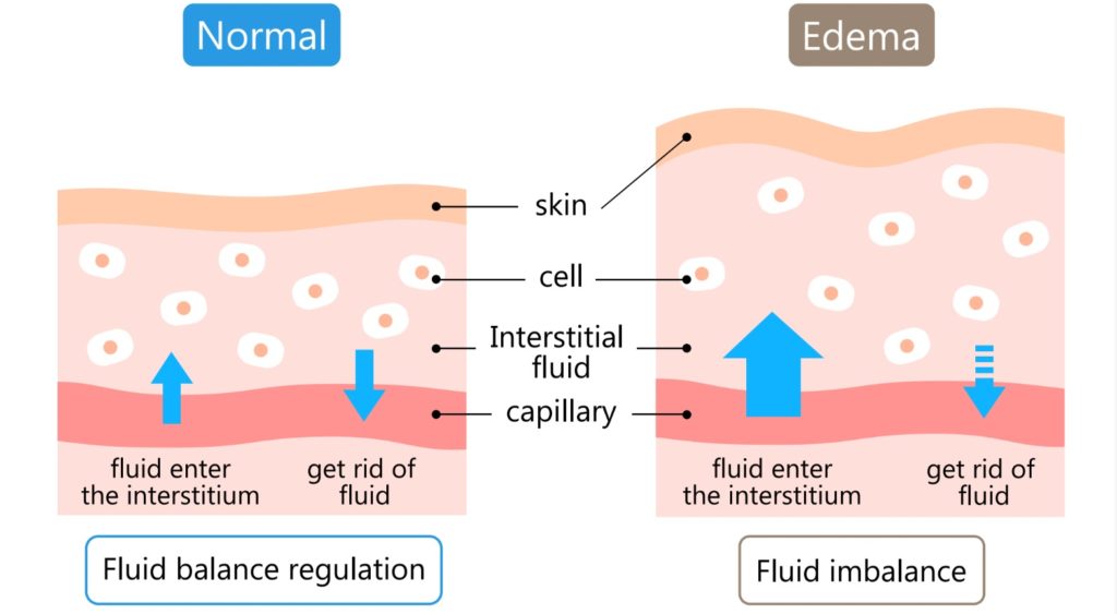 edema-what-it-is-possible-causes-symptoms-treatments