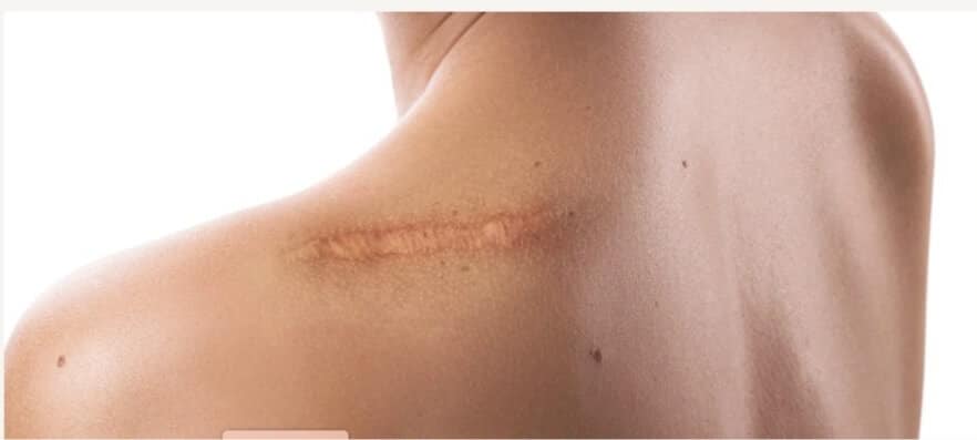 post surgery scar treatment