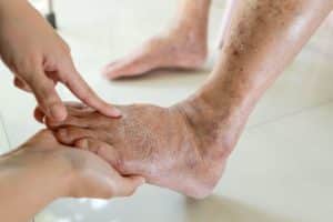Examining the foot of a person with peripheral arterial disease
