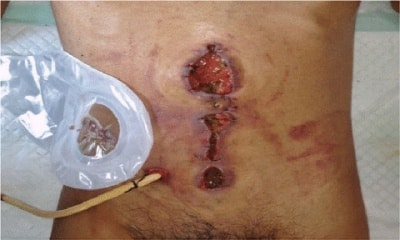 abdominal wound infection