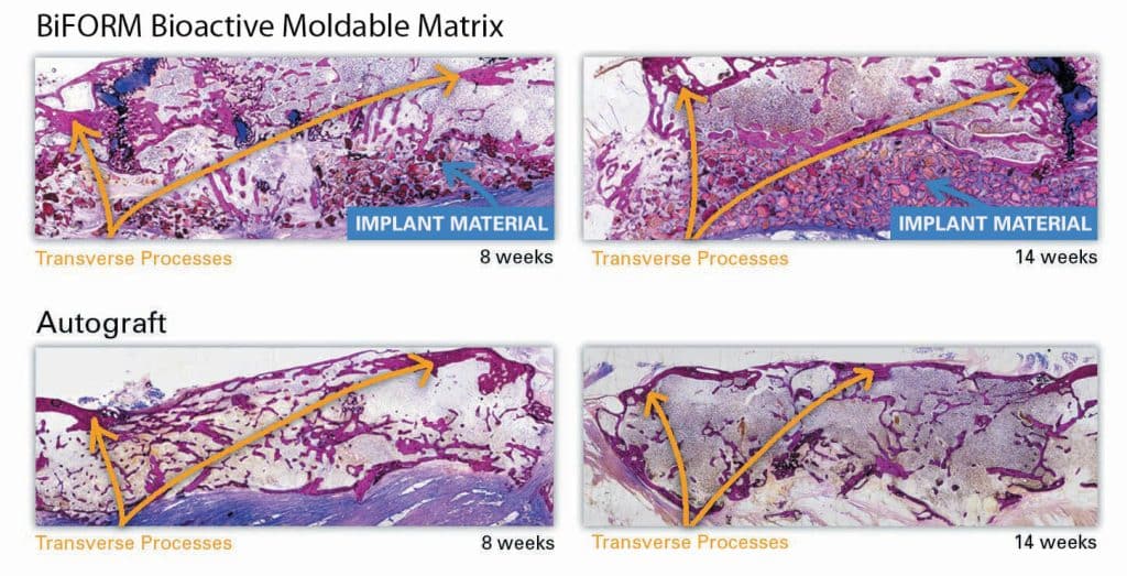 Representative Histological Images of BiFORM® Bioactive Moldable Matrix + autograft and autograft at 8- and 14-weeks post implantation